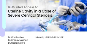 IR-Guided Access to Uterine Cavity in a Case of Severe Cervical Stenosis