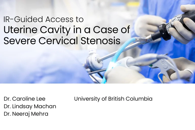 IR-Guided Access to Uterine Cavity in a Case of Severe Cervical Stenosis