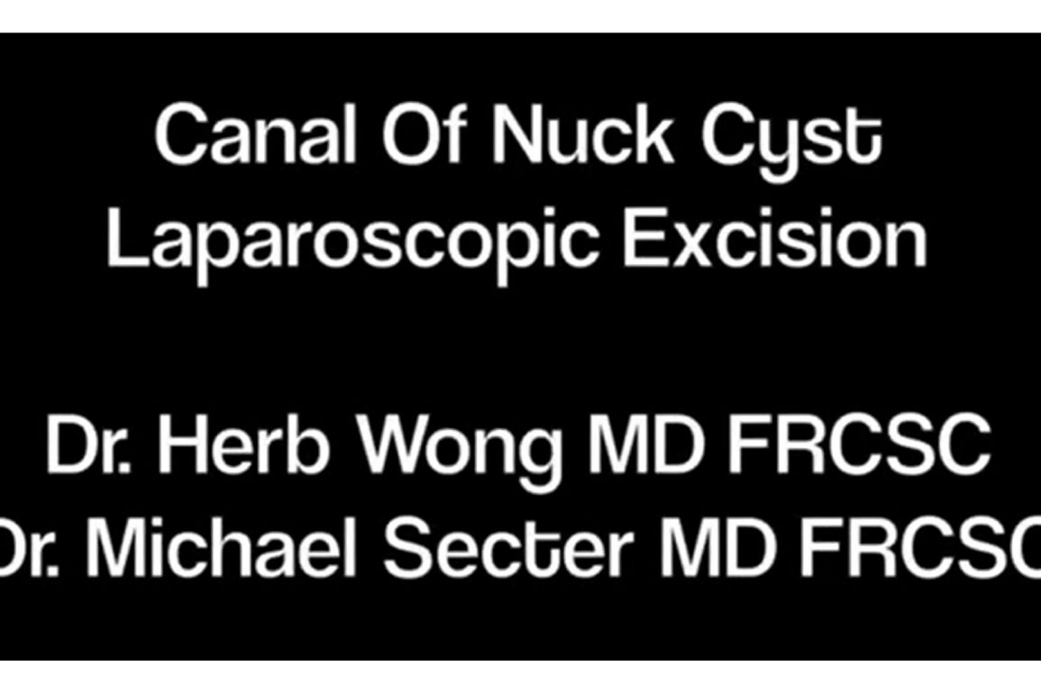 Canal Of Nuck Cyst Laparoscopic Excision