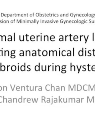 Proximal Uterine Artery Ligation Navigating Anatomical Distortion of Large Fibroids During Hysterectomy