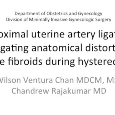 Proximal Uterine Artery Ligation Navigating Anatomical Distortion of Large Fibroids During Hysterectomy