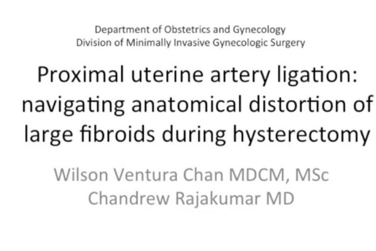 Proximal Uterine Artery Ligation Navigating Anatomical Distortion of Large Fibroids During Hysterectomy
