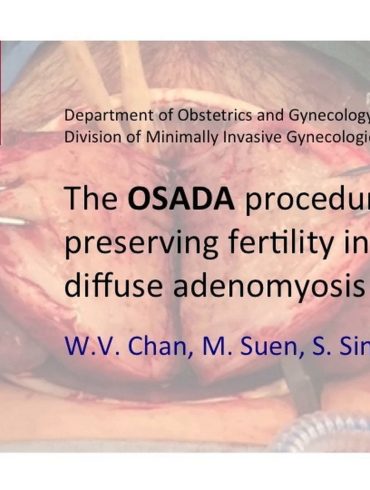 The OSADA Procedure Preserving Fertility in Diffuse Adenomyosis