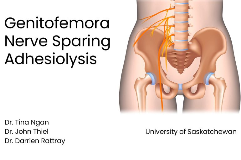 Genitofemoral Nerve Sparing Adhesiolysis