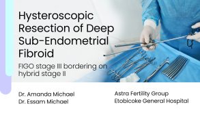 Hysteroscopic Resection of Deep Sub-Endometrial Fibroid (FIGO stage III bordering on hybrid stage II) 15 Hysteroscopic Resection of Deep Sub-Endometrial Fibroid (FIGO stage III bordering on hybrid stage II)