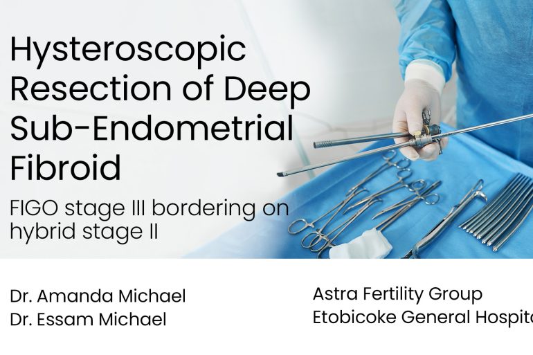 Hysteroscopic Resection of Deep Sub-Endometrial Fibroid (FIGO stage III bordering on hybrid stage II)