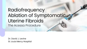 Radiofrequency Ablation of Symptomatic Uterine Fibroids: The Acessa Procedure 27 Radiofrequency Ablation of Symptomatic Uterine Fibroids: The Acessa Procedure preview