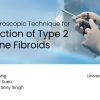 Hysteroscopic Technique for Resection of Uterine Fibroids