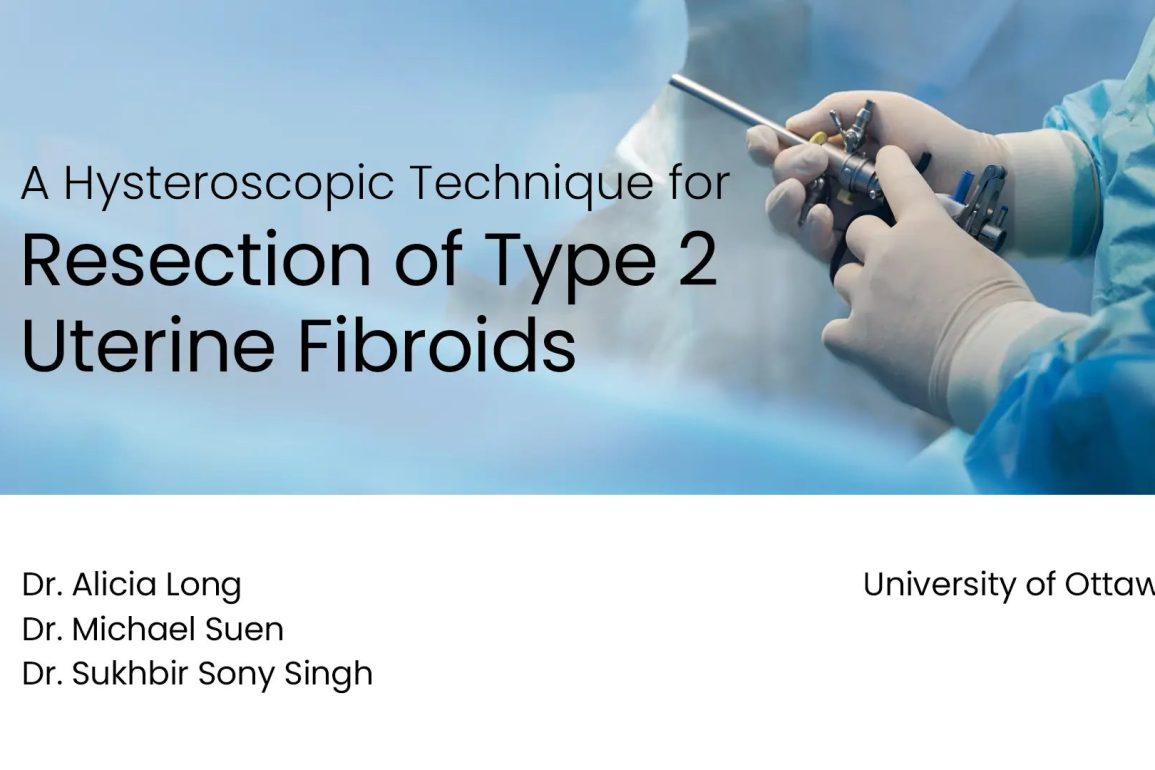 Hysteroscopic Technique for Resection of Uterine Fibroids