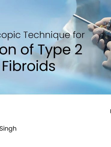 Hysteroscopic Technique for Resection of Uterine Fibroids