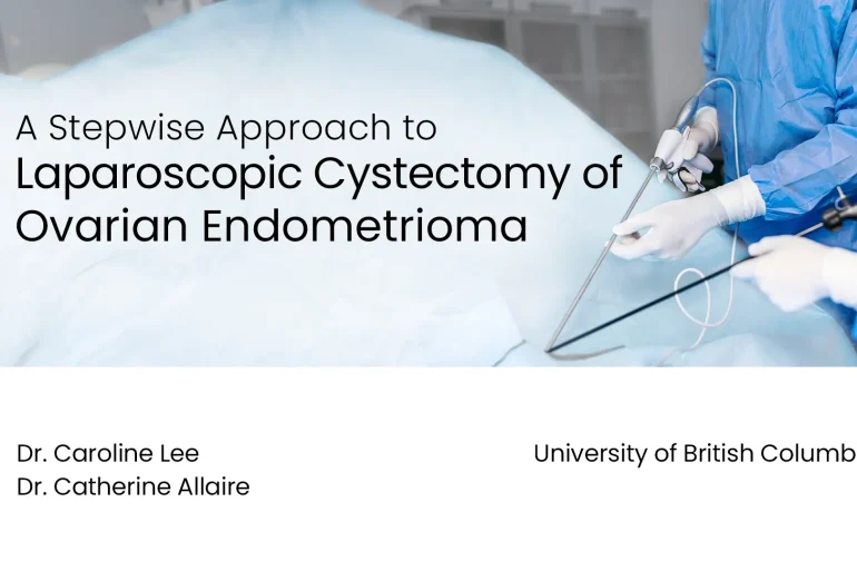 A Step-wise Approach to Laparoscopic Cystectomy of Ovarian Endometrioma