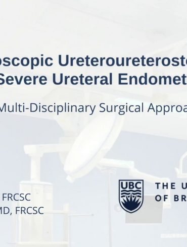 Laparoscopic Ureteroureterostomy to Treat Severe Ureteral Endometriosis