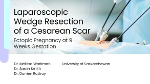 Laparoscopic Wedge Resection of a Cesarean Scar Ectopic Pregnancy at 9 Weeks Gestation 89 Laparoscopic Wedge Resection of a Cesarean Scar Ectopic Pregnancy at 9 Weeks Gestation