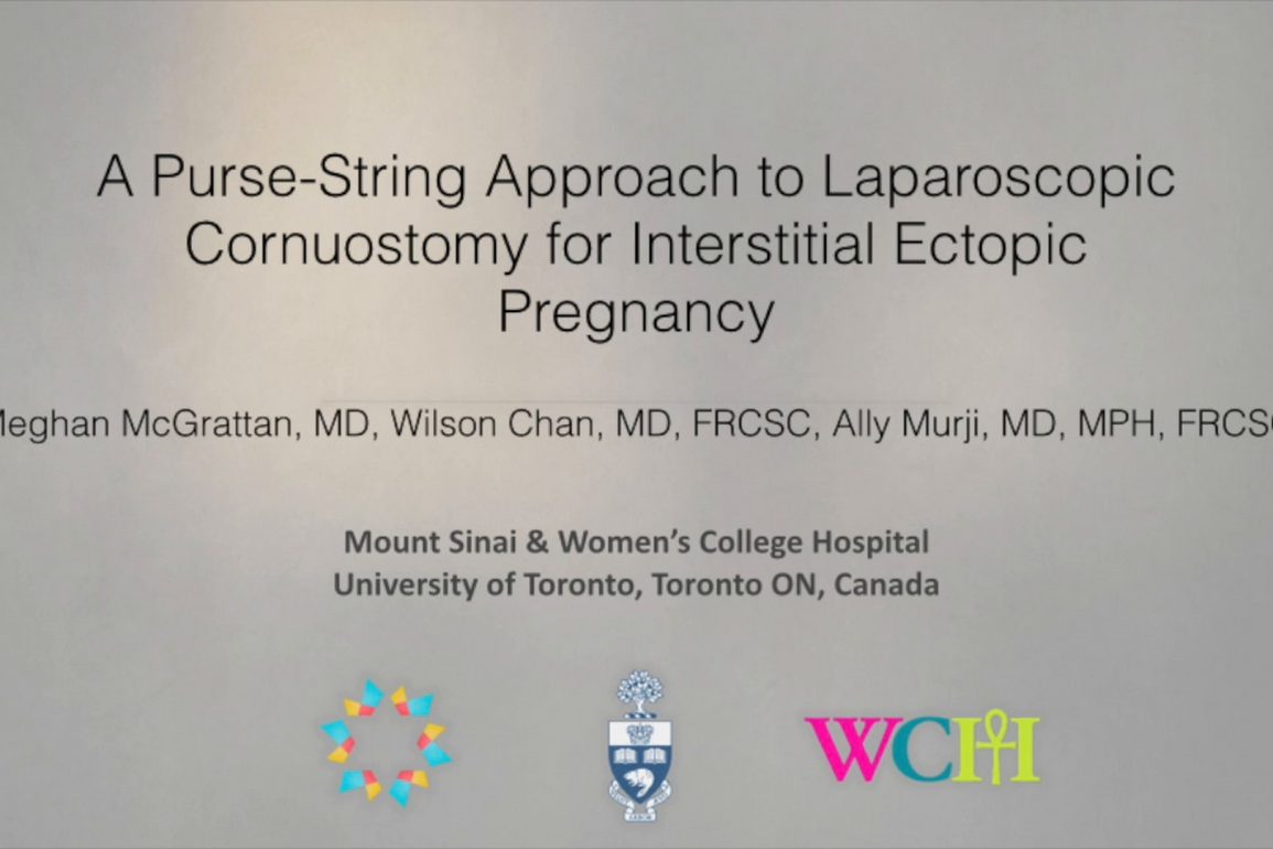 A Purse-String Approach to Laparoscopic Cornuostomy for Interstitial Ectopic Pregnancy