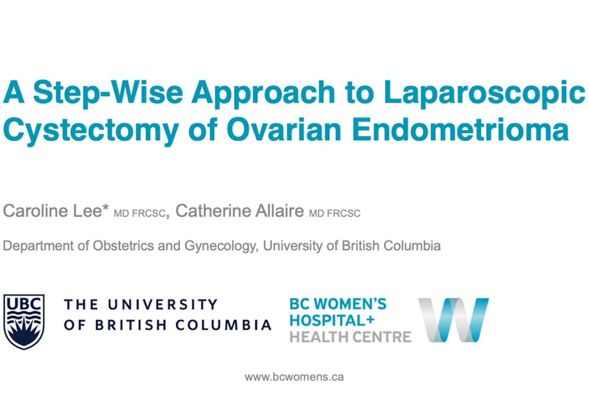 A Step-wise Approach to Laparoscopic Cystectomy of Ovarian Endometrioma