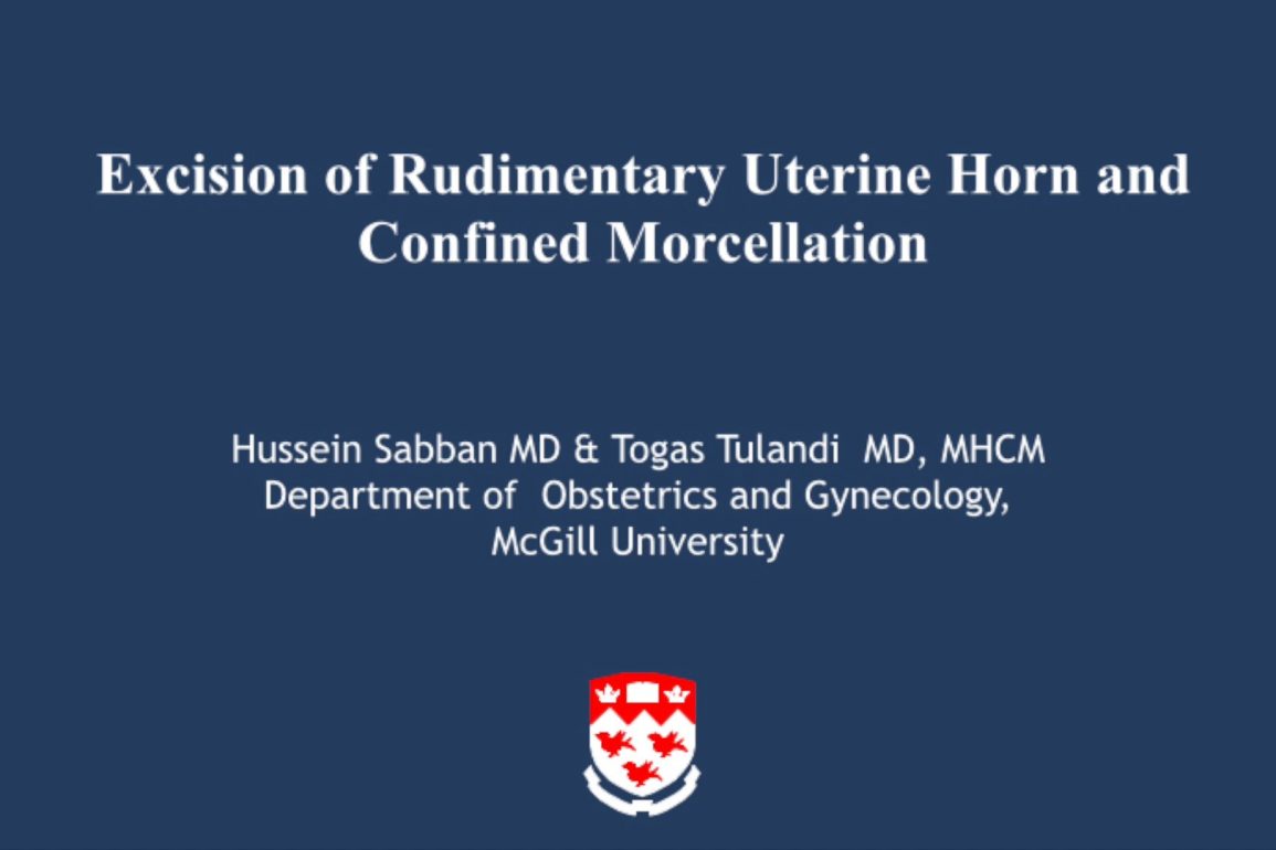 Excision of Rudimentary Uterine Horn and Confined Morcellation