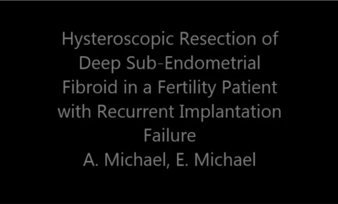 Hysteroscopic Resection of Deep Sub-Endometrial Fibroid (FIGO stage III bordering on hybrid stage II)