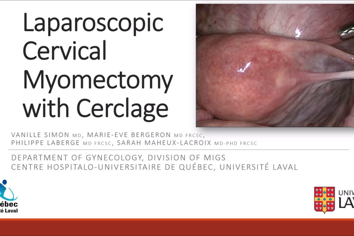 Laparoscopic Cervical Myomectomy with Pre-operative Uterine Artery Embolization and Concomitant Cerclage