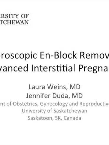 Laparoscopic En-Block Removal of Advanced Interstitial Pregnancy