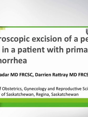 Laparoscopic Excision of a Pelvic Mass in a Patient with Primary Amenorrhea
