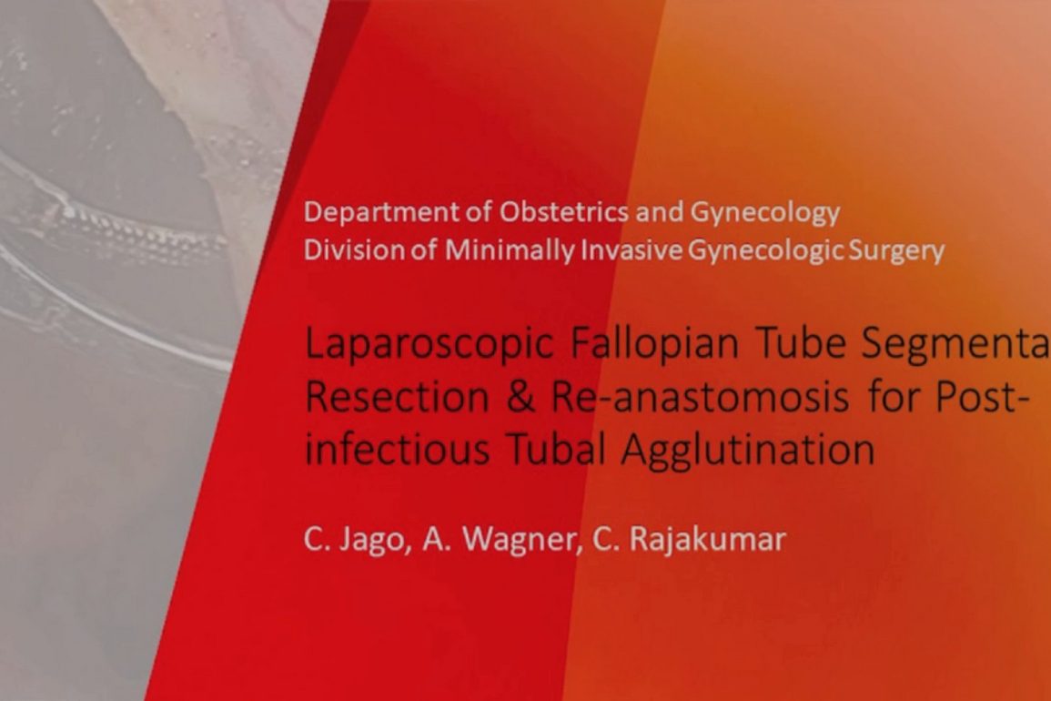 Laparoscopic Fallopian Tube Segmental Resection and Re-anastomosis for Post-infectious Tubal Agglutination