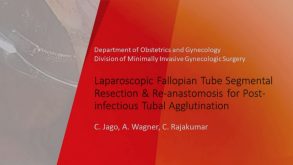 Laparoscopic Fallopian Tube Segmental Resection and Re-anastomosis for Post-infectious Tubal Agglutination