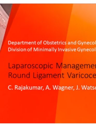 Laparoscopic Management of Round Ligament Varicocele
