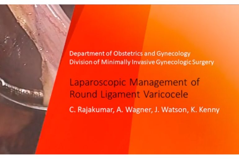 Laparoscopic Management of Round Ligament Varicocele