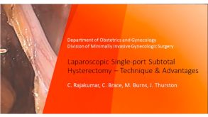 Laparoscopic Single-Port Subtotal Hysterectomy – Technique & Advantages 28 Laparoscopic Single-Port Subtotal Hysterectomy – Technique & Advantages