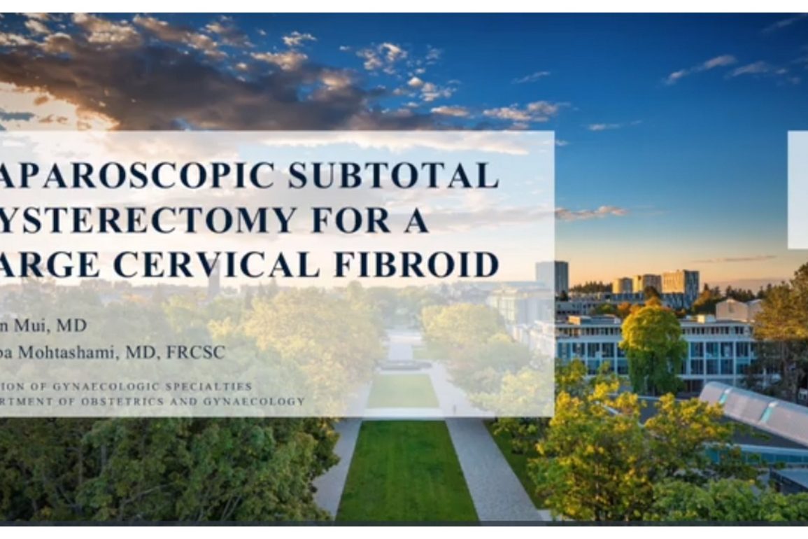 Laparoscopic Subtotal Hysterectomy for a Large Cervical Fibroid