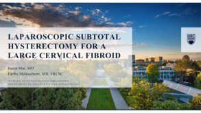 Laparoscopic Subtotal Hysterectomy for a Large Cervical Fibroid 18 Laparoscopic Subtotal Hysterectomy for a Large Cervical Fibroid