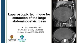 Laparoscopic Technique for Extraction of Large Abdominopelvic Masses