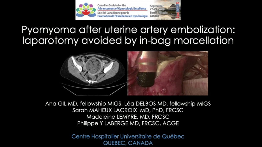 Laparotomy Avoided by In-bag Morecellation