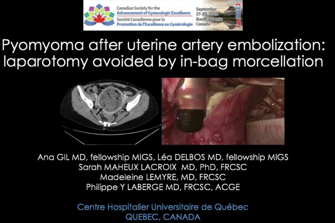Pyomyoma After Uterine Artery Embolization Laparotomy Avoided by In-bag Morecellation