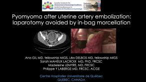 Pyomyoma After Uterine Artery Embolization Laparotomy Avoided by In-bag Morecellation