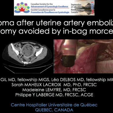 Pyomyoma After Uterine Artery Embolization Laparotomy Avoided by In-bag Morecellation