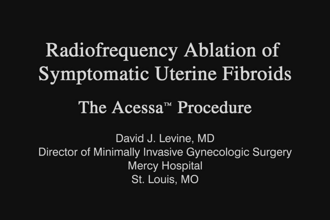Radiofrequency Ablation of Symptomatic Uterine Fibroids The Acessa Procedure