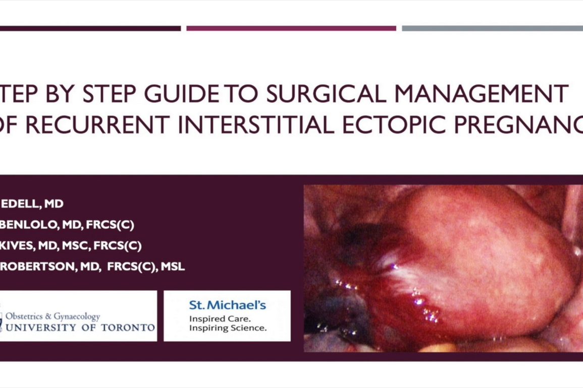 Step-by-Step Guide to the Surgical Management of Interstitial Ectopic Pregnancy