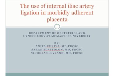 The Use of Internal Iliac Artery Ligation in Morbidly Adherent Placenta