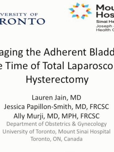 This video discusses tips and tricks in dissecting an adherent bladder safely at the time of total laparoscopic hysterectomy.