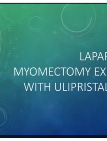This video outlines one surgeon’s laparoscopic experience with ulipristal acetate at myomectomy.