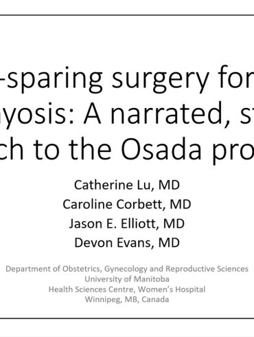This video describes a narrated, stepwise approach to the Osada procedure fertility-sparing surgery for severe adenomyosis.