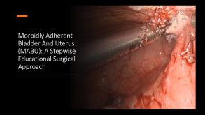 Morbidly Adherent Bladder and Uterus (MABU): A Stepwise Educational Surgical Approach