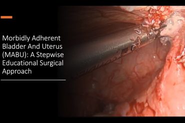 Morbidly Adherent Bladder and Uterus (MABU): A Stepwise Educational Surgical Approach