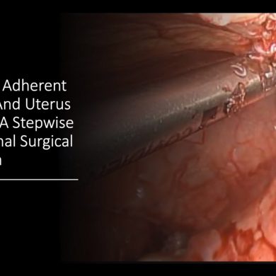 Morbidly Adherent Bladder and Uterus (MABU): A Stepwise Educational Surgical Approach