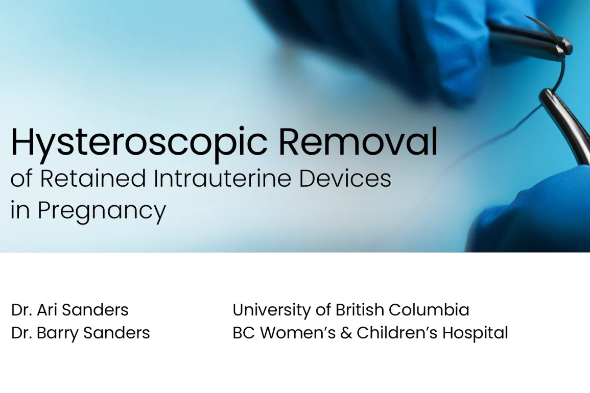 Hysteroscopic Removal of Retained Intrauterine Devices in Pregnancy