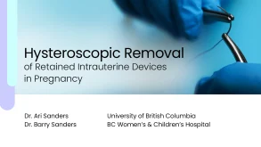 Hysteroscopic Removal of Retained Intrauterine Devices in Pregnancy 48 Hysteroscopic Removal of Retained Intrauterine Devices in Pregnancy