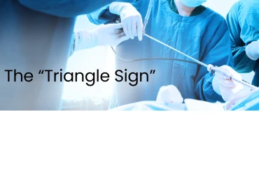 Introducing the Dynamic 'Triangle Sign' Technique