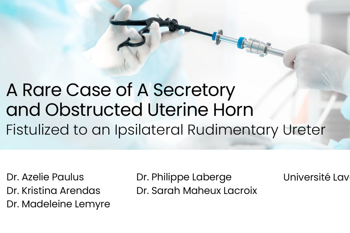 A Rare Case of a Secretory and Obstructed Uterine Horn Fistulized to an Ipsilateral Rudimentary Ureter