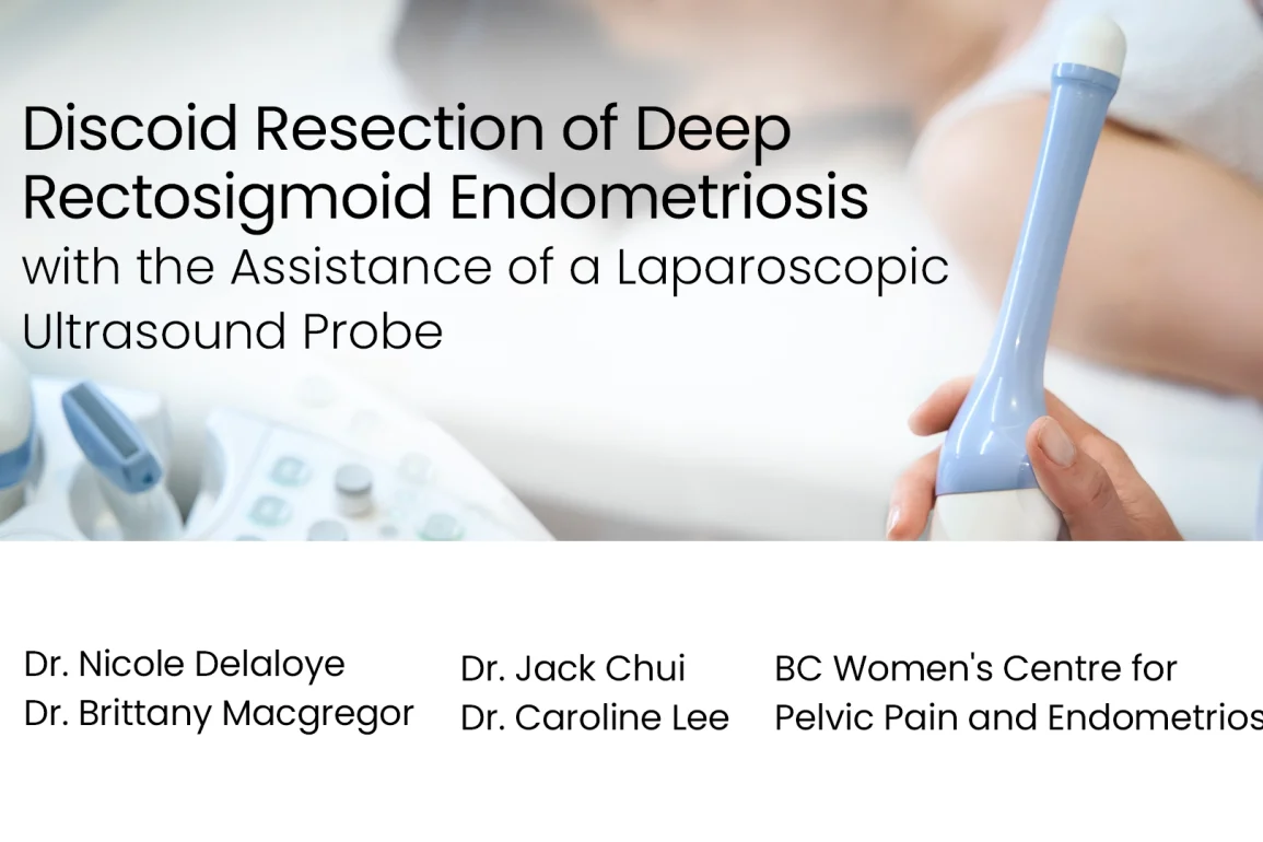 Discoid Resection of Deep Rectosigmoid Endometriosis with the Assistance of a Laparoscopic Ultrasound Probe